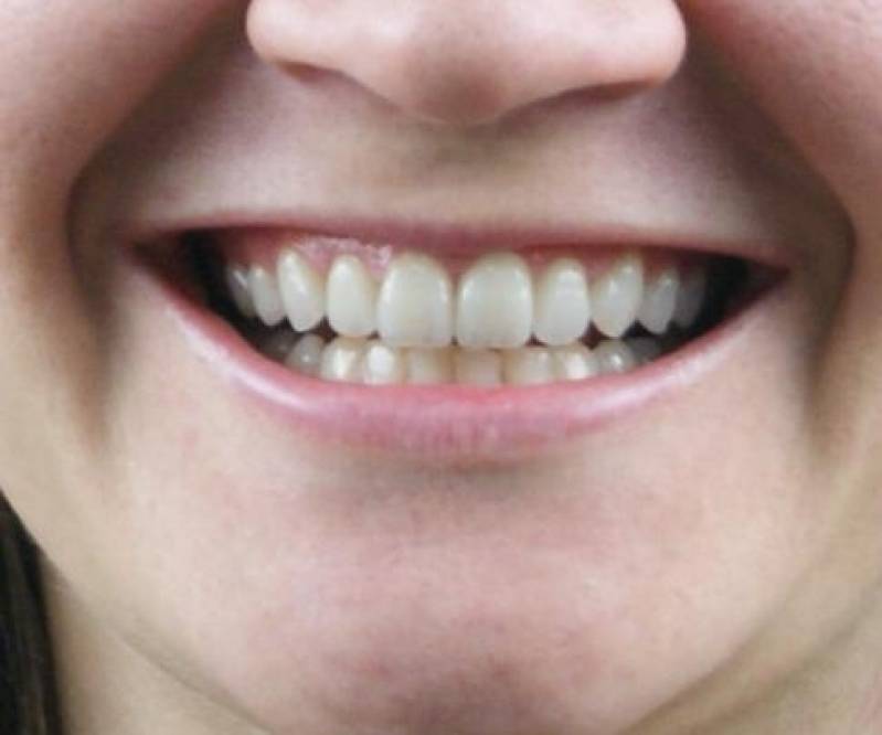 Lente de Contato Dental em Porcelana