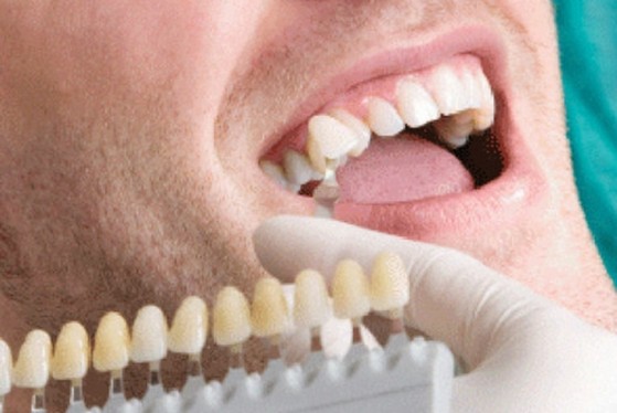 Lente de Contato para Dentes Tortos