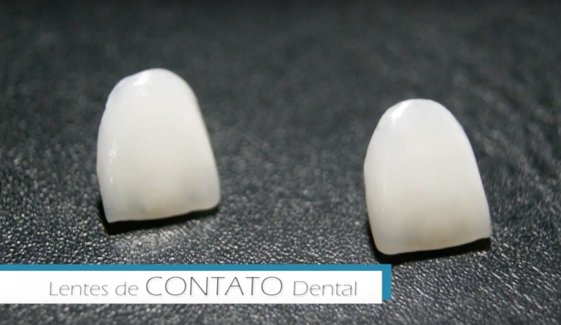 Lentes de Contato e Facetas de Porcelana