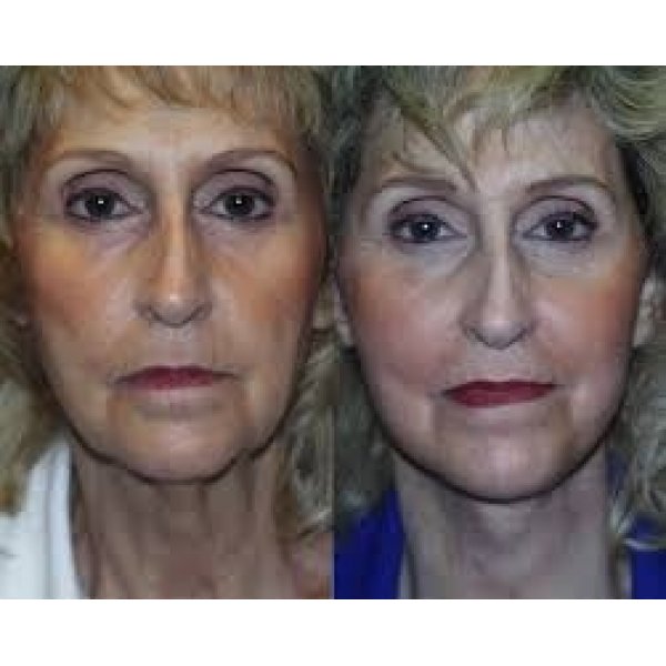 Lifting Facial no Centro