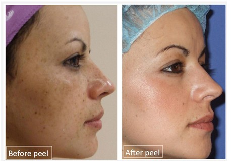 Limpeza de Pele com Peeling