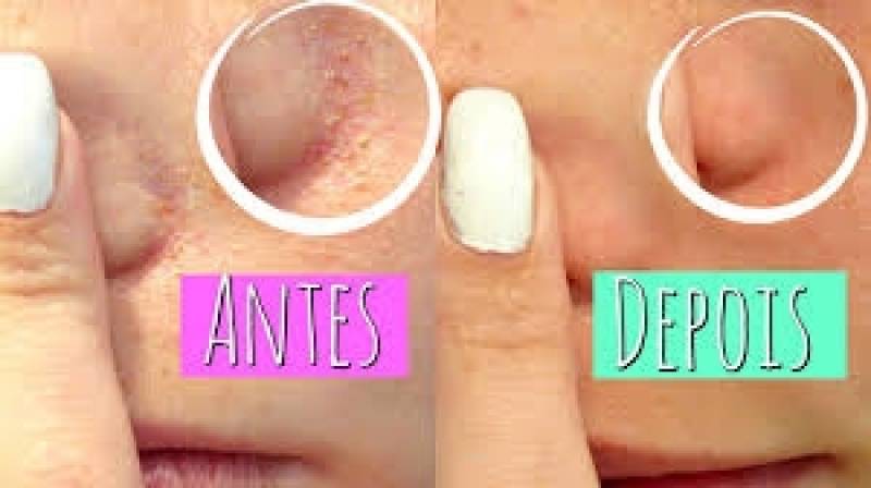 Limpeza de Pele para Tratamento de Acne