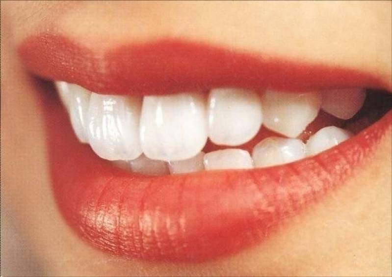 Limpeza e Clareamento Dental