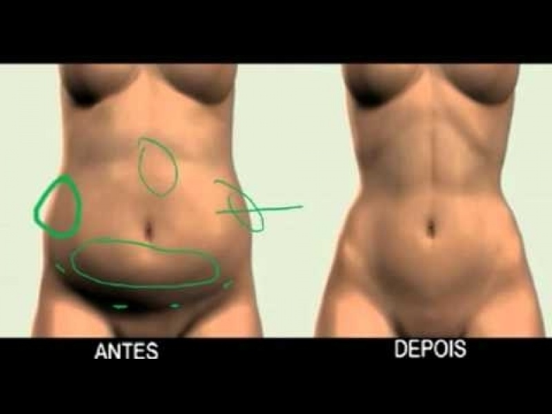 Lipoaspiração a Laser