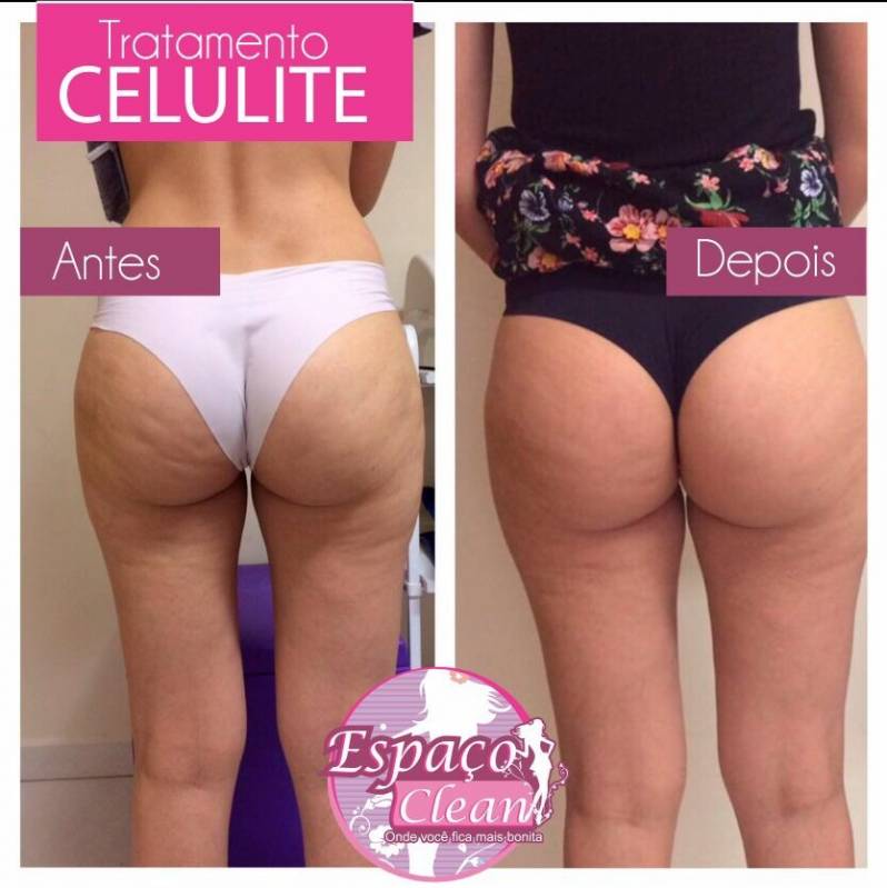 Lipocavitação para Culote