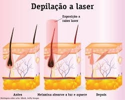 Locação de Equipamentos a Laser