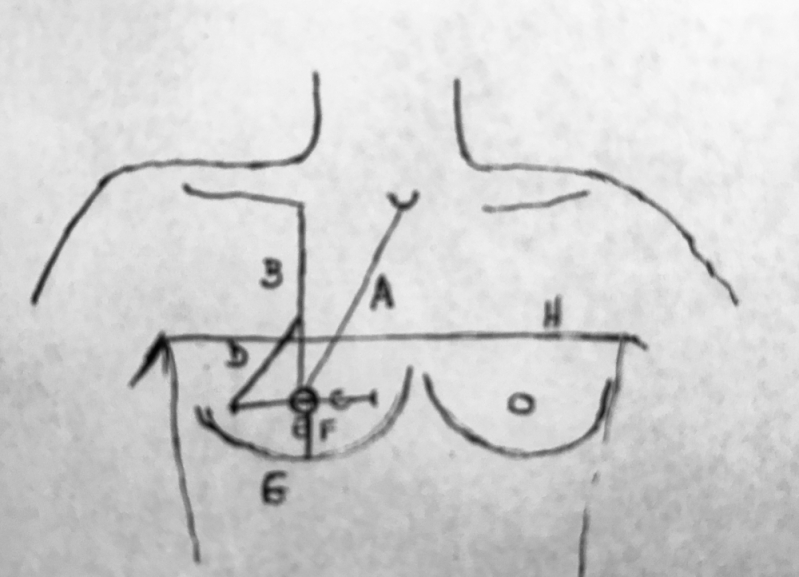 Mamoplastia Aumento