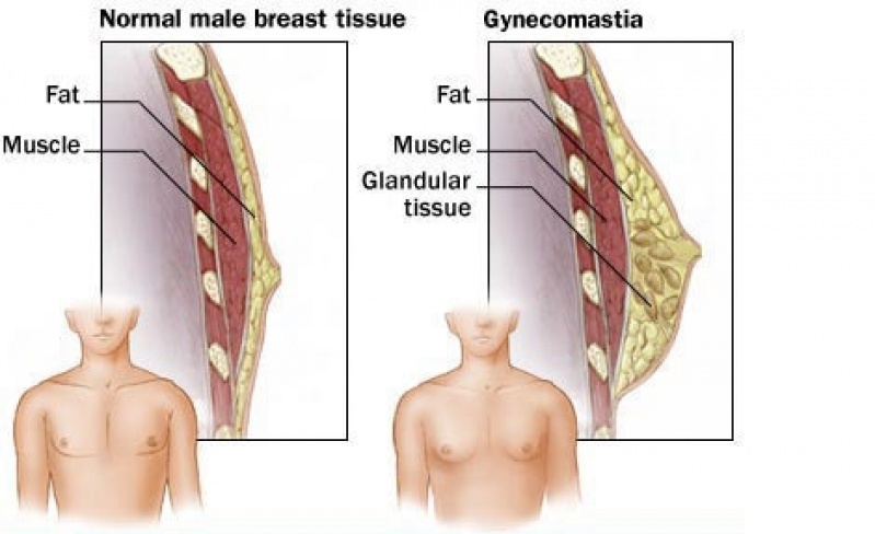 Mamoplastia Aureola