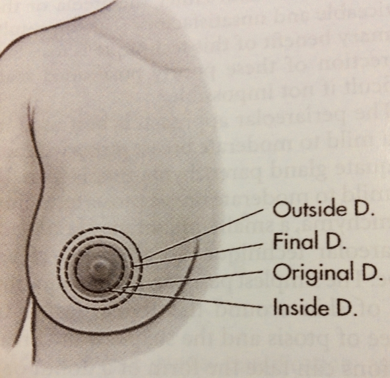 Mamoplastia Cirurgia