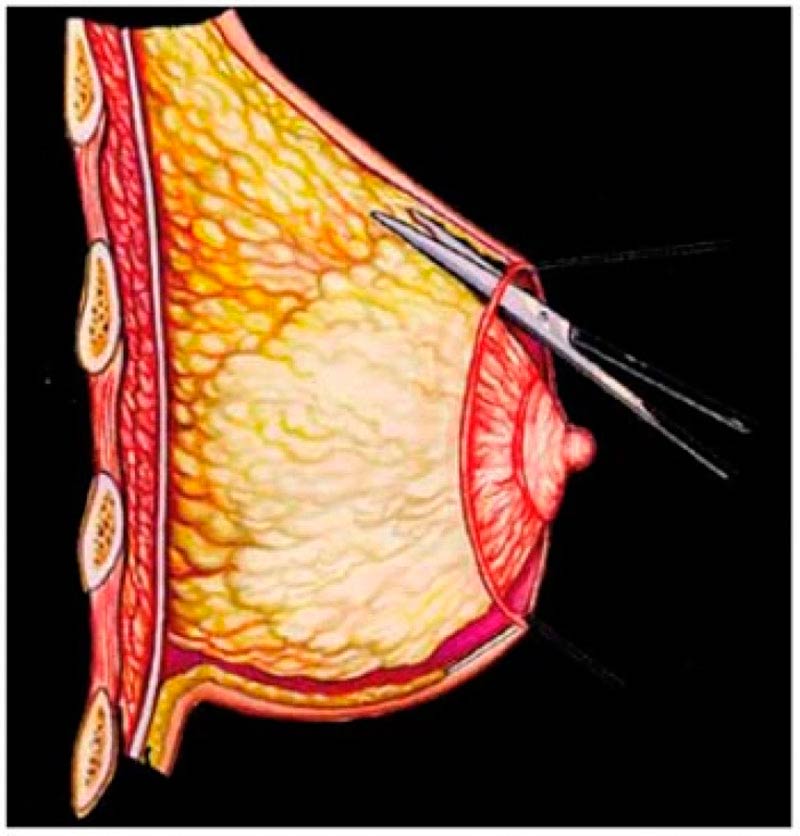 Mamoplastia com Prótese de Silicone