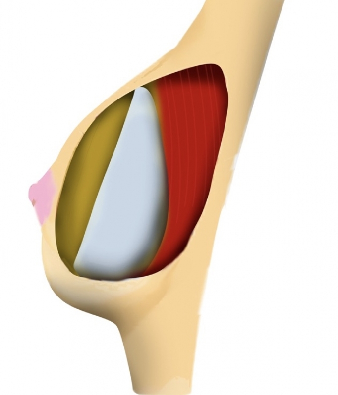 Mamoplastia para Aumento