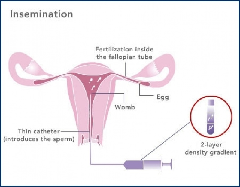 Medico de Inseminação