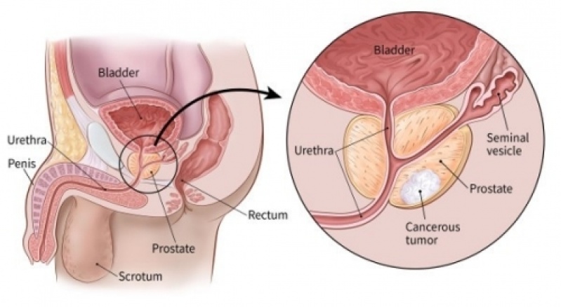 Médico para Homem Urologista