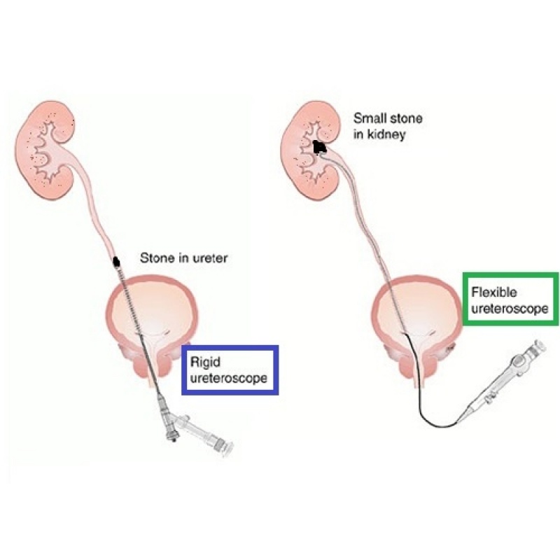 Médico para Tratamento de Cálculo Renal