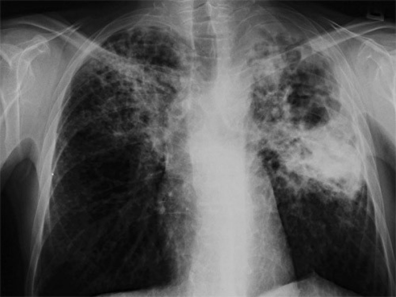 Médico Pneumologistas para Tratar Doenças Pulmonares