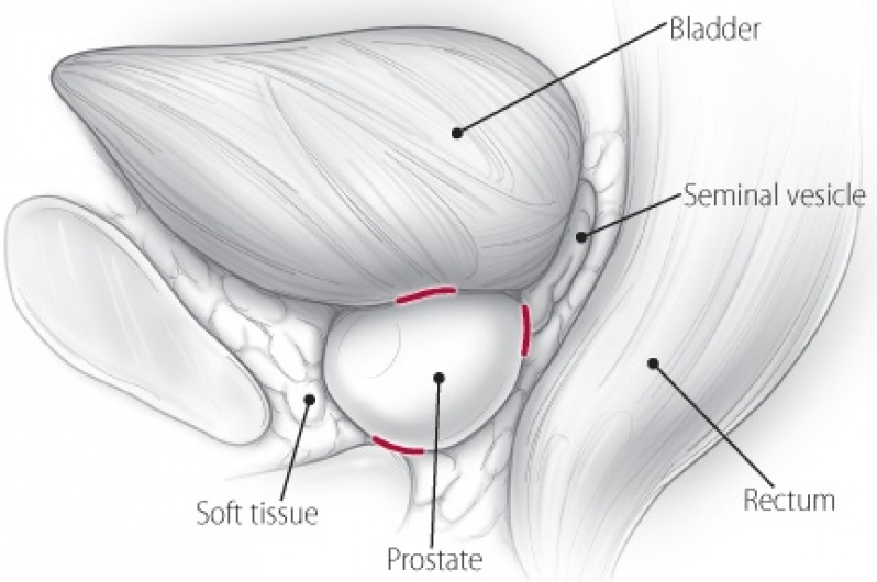 Médico Urologista para Câncer de Próstata