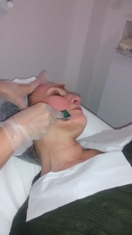 Microagulhamento e Peeling Químico