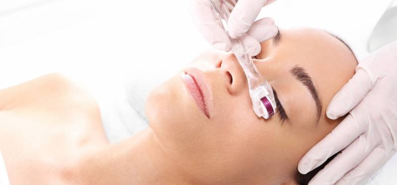 Microagulhamento para Acne