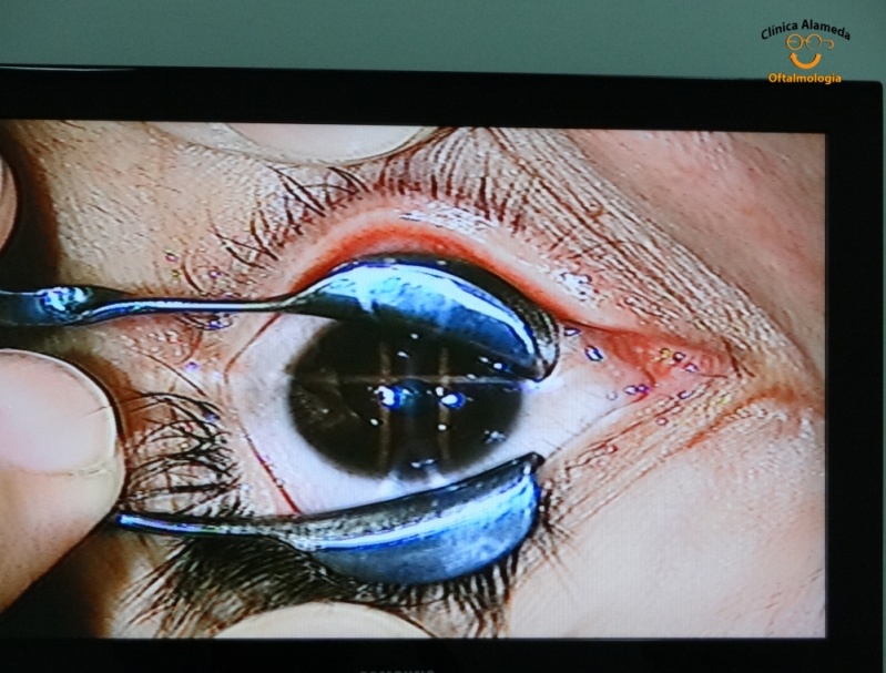 Operação Ocular a Laser