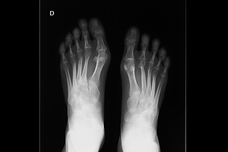 Osteoartrite de Quadril