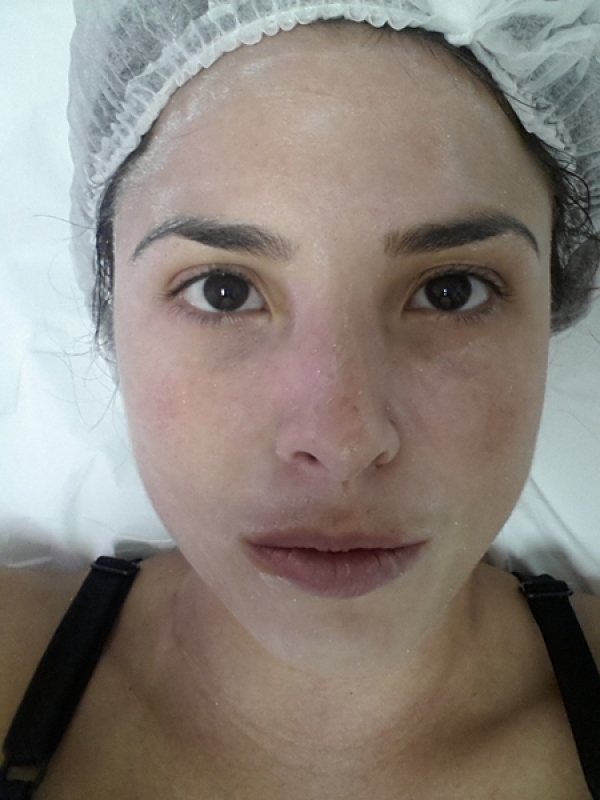 Peeling de ácido Tioglicólico Tratamento Facial