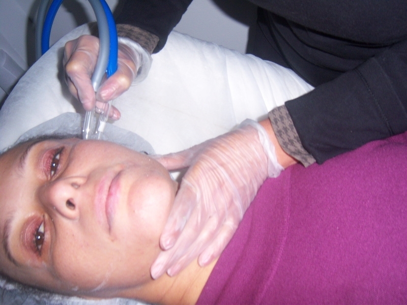 Peeling de Cristal Melasma