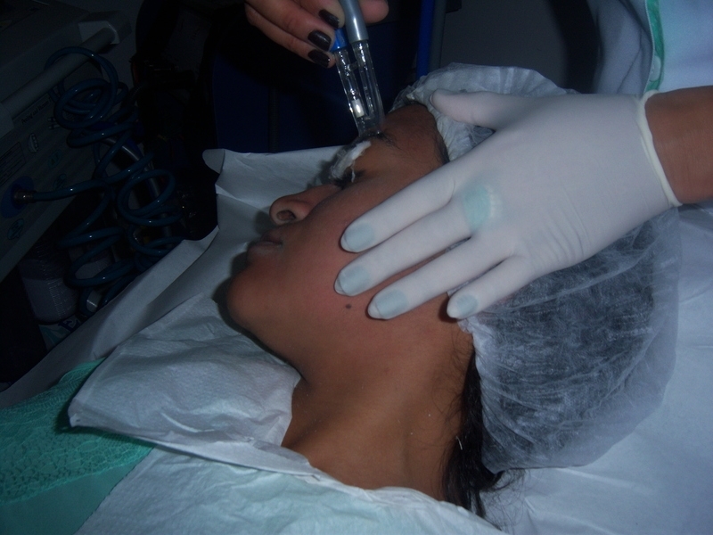 Peeling de Cristal para Manchas de Melasma