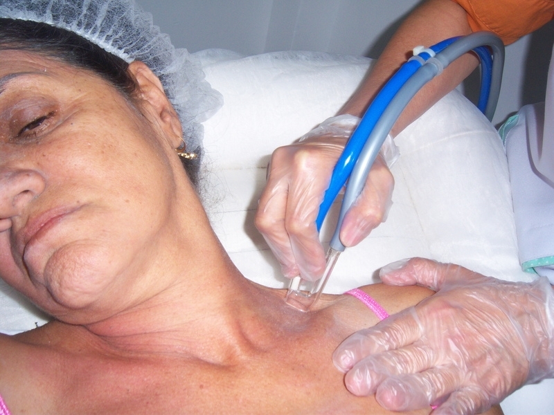 Peeling de Cristal Tirar Manchas de Melasma