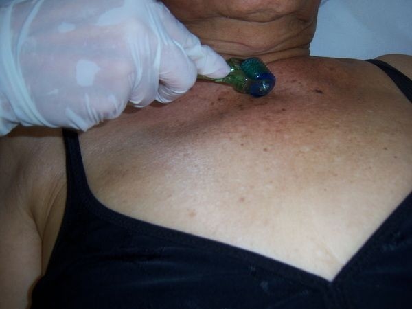 Peeling Químico Corporal