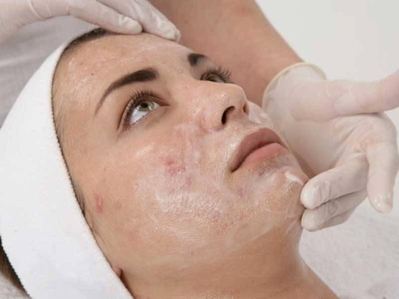 Peeling Químico para Melasma