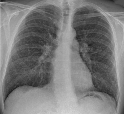 Pneumologista Especialista em Embolia Pulmonar