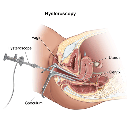 Popilo Endometrial