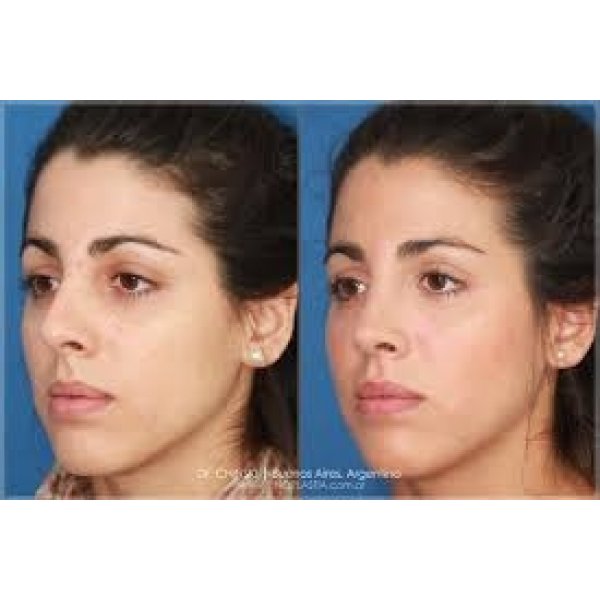 Preço Cirurgia Rinoplastia