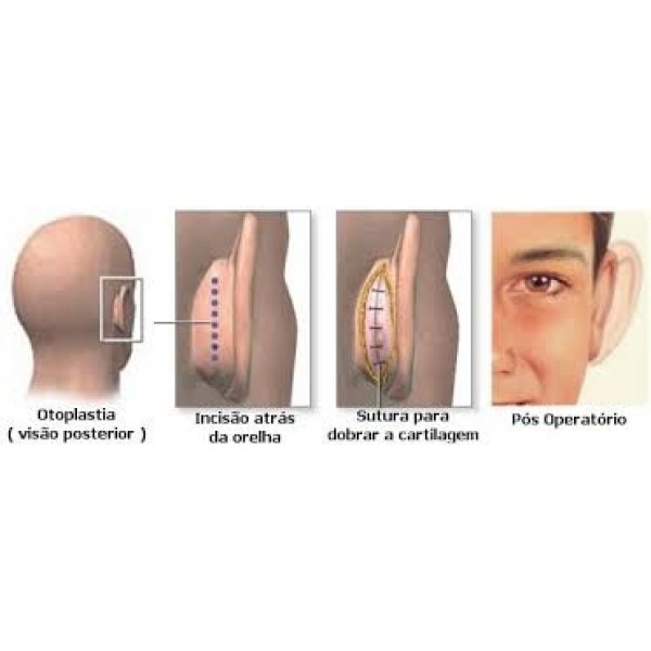 Preço da Cirurgia de Otoplastia