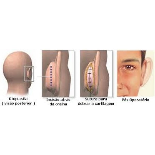 Preço da Cirurgia de Otoplastia