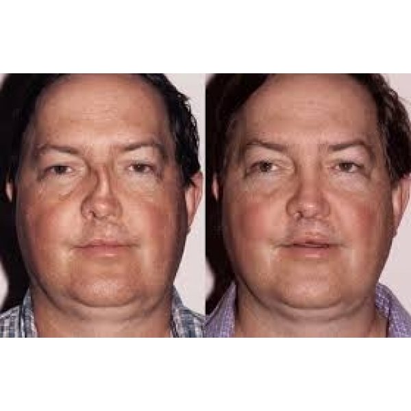 Preço Rinoplastia