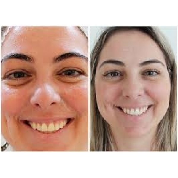 Preenchimento Facial na Zona Norte