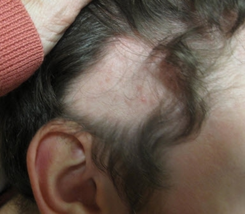 Prótese Capilar com Cabelo Sintético Feminino