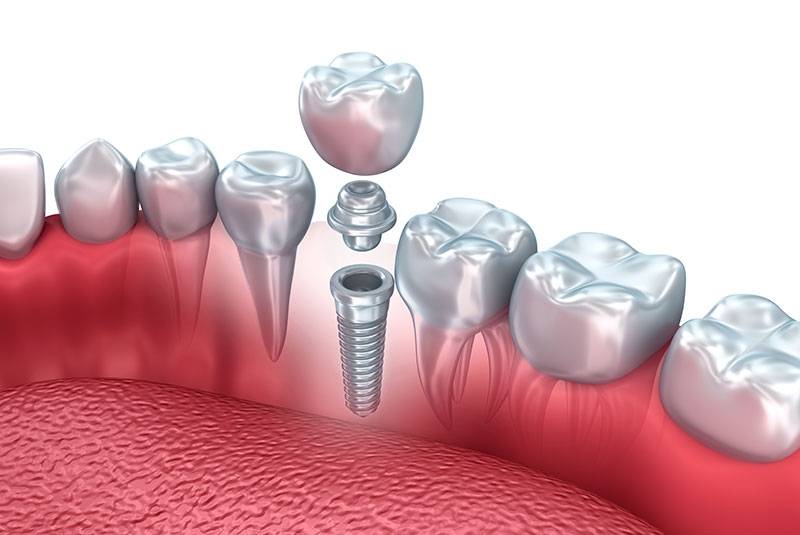 Prótese Dentária de Platina