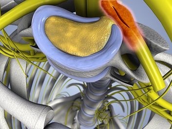 Quiropraxia Especializada em Hérnia de Disco
