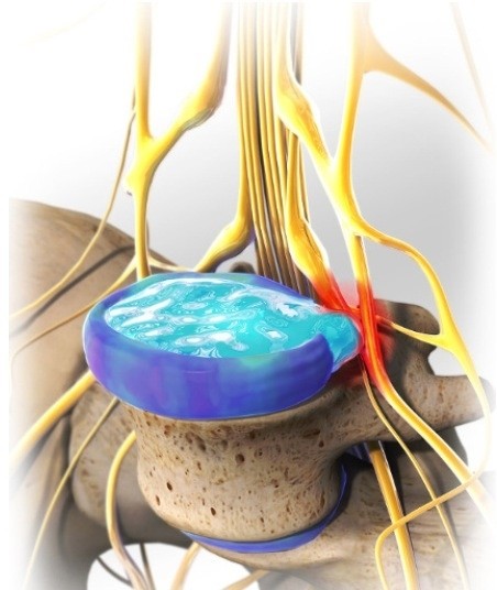 Quiropraxia para Hérnia de Disco