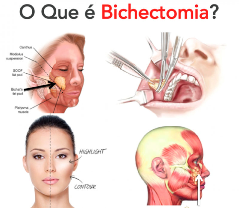 Redução de Bochechas