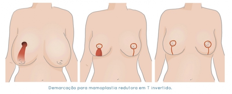 Redução de Mama