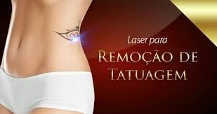 Remoção de Tatuagem a Laser