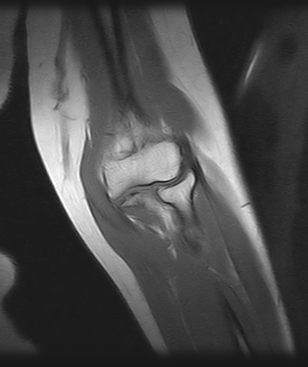 Ressonância Magnética Cotovelo Direito