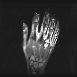 Ressonância Magnética da Mão em Barueri