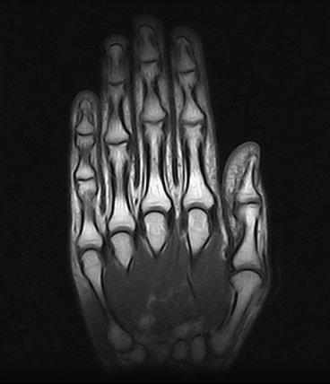 Ressonância Magnética da Mão em Osasco