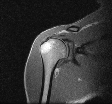 Ressonância Magnética de Ombro em Diadema