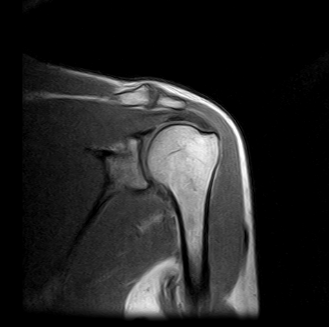 Ressonância Magnética de Ombro na Zona Norte