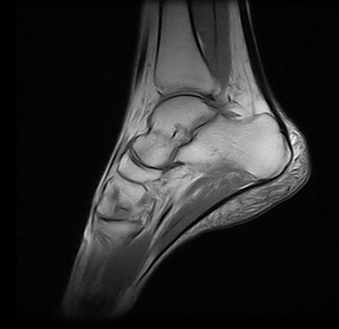 Ressonância Magnética de Tornozelo em São Caetano